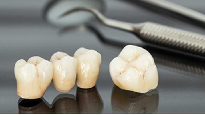 How-do-Digital-Crowns-and-Bridges-offer-Patients-Quality-Restorations How-do-Digital-Crowns-and-Bridges-offer-Patients-Quality-Restorations