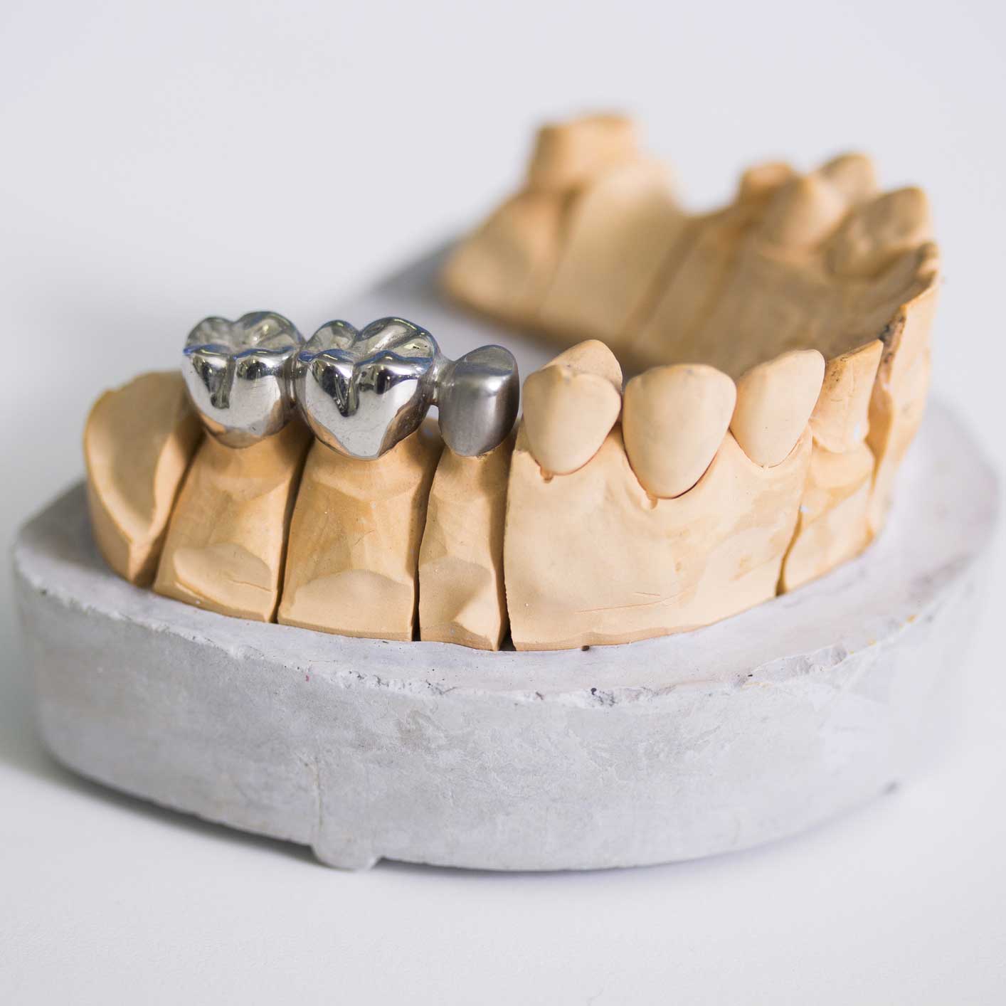 porcelin-fused-metal porcelin-fused-metal